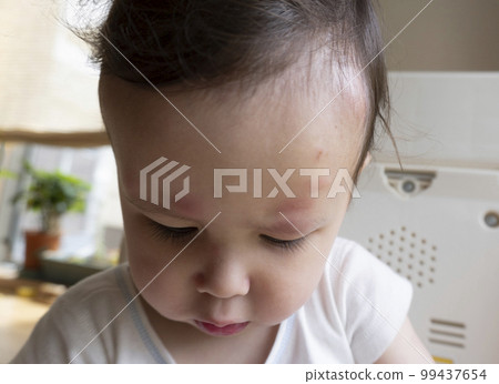 Face close-up of a 2-year-old boy with many insect bite marks on his face 99437654