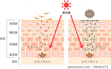 瑕疵的機制 皮膚橫截面 之前和之後 99482471