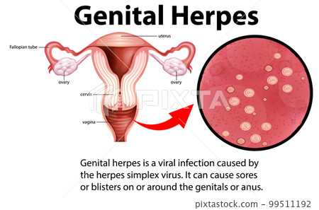 Genital Herpes infographic with explanation 99511192
