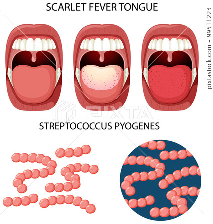 Scarlet fever tongue symptoms Scarlet fever tongue symptoms 99511223