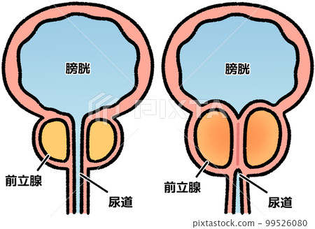 Normal prostate and enlarged prostate (with names) 99526080