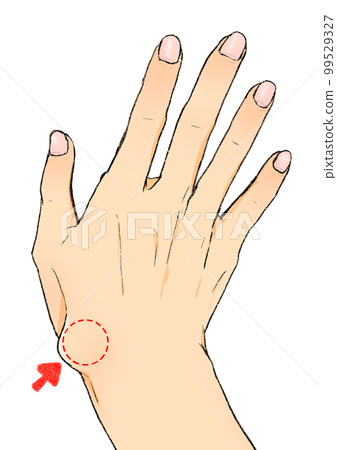 A hand with a ganglion above the wrist below the thumb 99529327