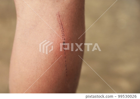 Dry wound skin on kid leg from playing in daily life. health care wound for healthy concept. 99530026