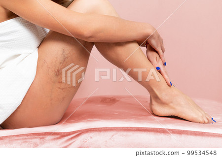 A slender woman is sitting on a pink velvet sofa, showing vascular inflammation on her thigh. Side view. The concept of varicose veins and varicosity 99534548