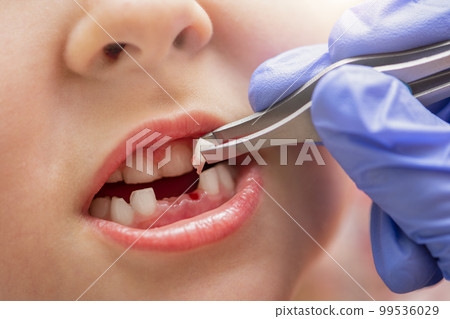 Removal of a milk tooth. The doctor pulled out a tooth from a child with tweezers. Extraction of a child's tooth with a dental instrument. 99536029