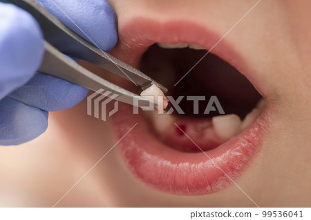 Removal of a milk tooth. The doctor pulled out a tooth from a child with tweezers. Extraction of a child's tooth with a dental instrument. 99536041