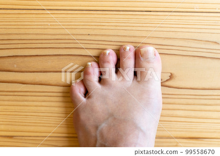 Feet of a middle-aged woman whose little finger is a sleeping finger 99558670