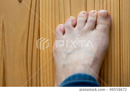 Feet of a middle-aged woman whose little finger is a sleeping finger Feet of a middle-aged woman whose little finger is a sleeping finger 99558672