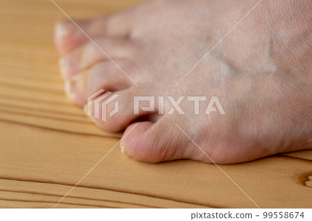 Feet of a middle-aged woman whose little finger is a sleeping finger 99558674