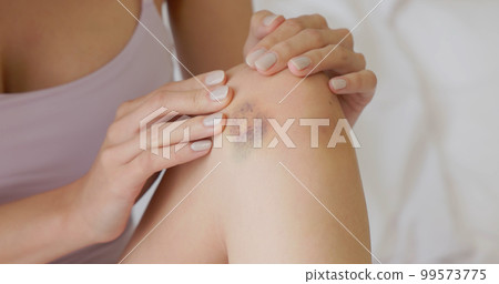 Bruise wound on female leg 99573775