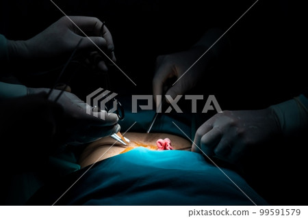 Closeup surgical team performing surgery to patient in sterile operating room. Closeup surgical team performing surgery to patient in sterile operating room. 99591579