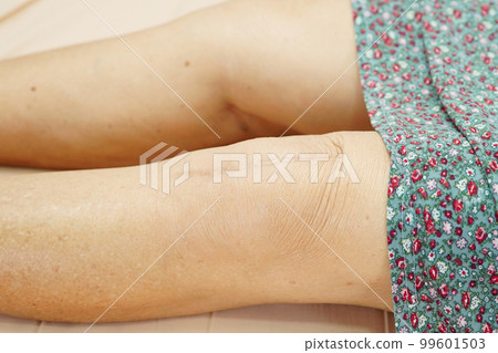 Asian elderly woman patient with scar knee replacement surgery in hospital. Asian elderly woman patient with scar knee replacement surgery in hospital. 99601503