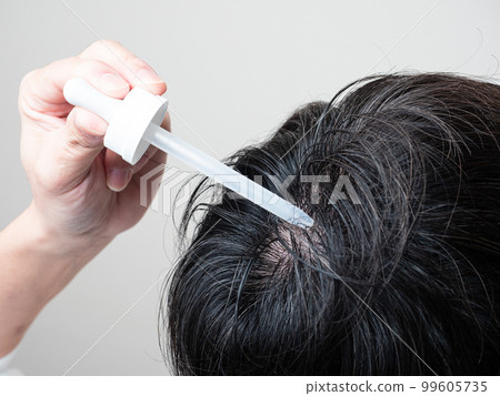 Man who applies hair restorer, whorl hair 99605735