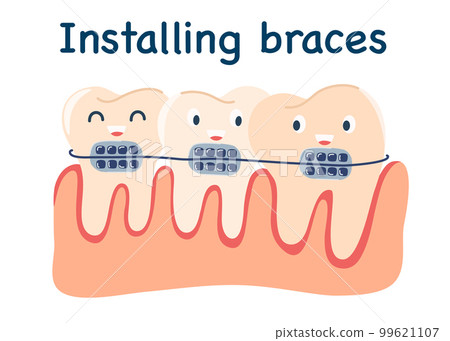 0127_braces 99621107