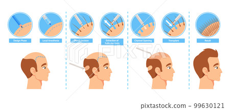 A Step-by-step Infographic To Hair Transplantation Procedure. Design Phase, Local Anesthesia, Punch Incision A Step-by-step Infographic To Hair Transplantation Procedure. Design Phase, Local Anesthesia, Punch Incision 99630121
