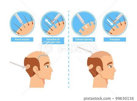 Hair Transplantation Procedure Infographics. Punch Incision, Extraction of Follicular Units, Channel Opening, Transplant Hair Transplantation Procedure Infographics. Punch Incision, Extraction of Follicular Units, Channel Opening, Transplant 99630138