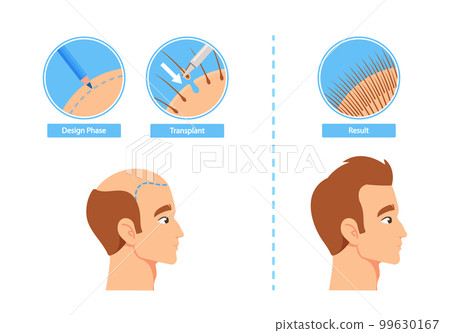Hair Transplantation Process Infographics Including Design Phase, Transplant and Result Stages. Before and After Images Hair Transplantation Process Infographics Including Design Phase, Transplant and Result Stages. Before and After Images 99630167