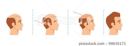 Hair Transplantation Procedure Stages, Male Scalp Before And After. Visual Aids For Medical Or Educational Materials Hair Transplantation Procedure Stages, Male Scalp Before And After. Visual Aids For Medical Or Educational Materials 99630171