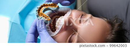 Simulation of artificial teeth on plaster model and patient with open mouth at dentist appointment 99642003