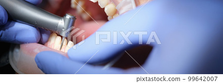 Dentist prepares woman teeth for the installation of ceramic veneers and crowns using drill Dentist prepares woman teeth for the installation of ceramic veneers and crowns using drill 99642007
