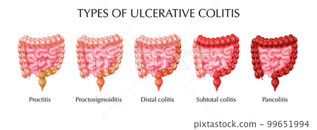 Ulcerative Colitis Types Infographics Ulcerative Colitis Types Infographics 99651994