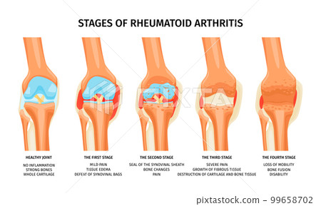 Rheumatoid Arthritis Stages Infographics 99658702