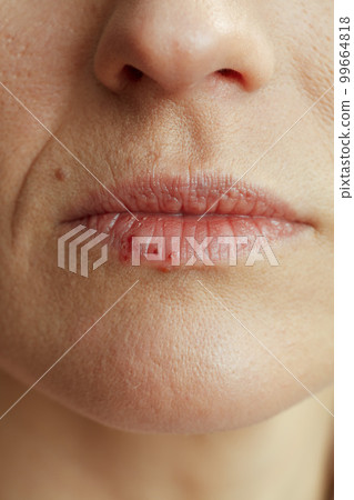 Closeup on woman with herpes on lips on beige background 99664818