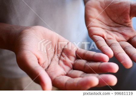 close up of Dry cracked skin of a men's hand close up of Dry cracked skin of a men's hand 99681119