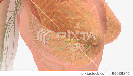 Stage III breast tumors are invasive and have spread to the lymph nodes around the collar bone or those deep within the breast. Stage III breast tumors are invasive and have spread to the lymph nodes around the collar bone or those deep within the breast. 99689845