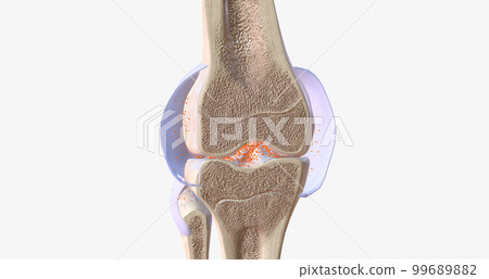 RA is caused by immune cells attacking the body's own synovial membranes, leading to joint swelling and the formation of auto-antibodies. RA is caused by immune cells attacking the body's own synovial membranes, leading to joint swelling and the formation of auto-antibodies. 99689882