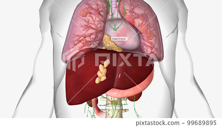 Stage IV cancer often spreads to the lungs, liver, and bones. 99689895