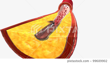 Atherothrombosis is a cardiovascular disease characterized by ruptured atherosclerotic plaque and clot formation. 99689902
