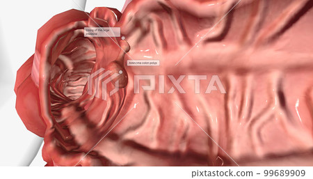 Adenomatous polyps are gland-like growths that develop on the mucous membrane lining the large intestine. Adenomatous polyps are gland-like growths that develop on the mucous membrane lining the large intestine. 99689909