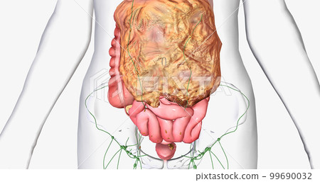 Stage III ovarian cancer has spread beyond the pelvis area to the abdomen. 99690032