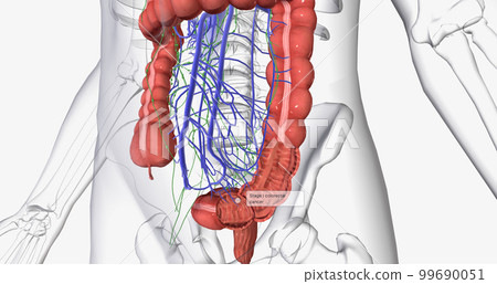 Colorectal cancer (CRC) is a common colon or rectal cancer that affects many patients over middle age. Colorectal cancer (CRC) is a common colon or rectal cancer that affects many patients over middle age. 99690051