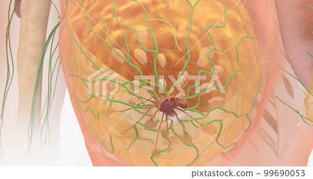 Stage I breast tumors are invasive and have started to spread to the fatty breast tissue or to nearby lymph nodes. Stage I breast tumors are invasive and have started to spread to the fatty breast tissue or to nearby lymph nodes. 99690053