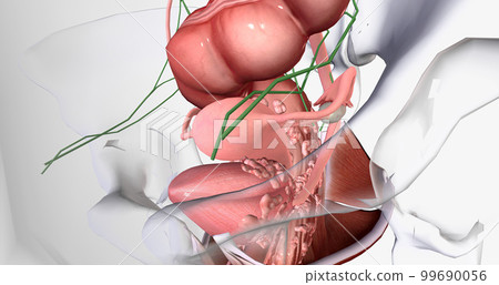 In stage IV, the cancer spreads to invade nearby organs, such as the bladder, rectum, and kidneys. 99690056