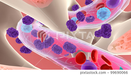 Lymphoblasts invaded and eventually replace healthy bone marrow, preventing the production of blood cells. 99690066