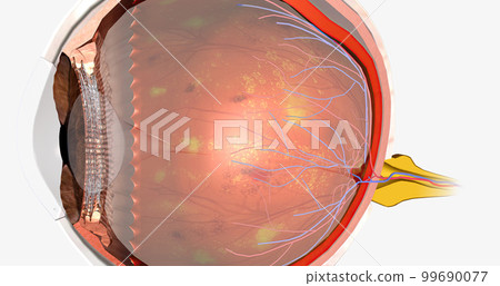 Diabetic retinopathy is a complication of diabetes that affects the eyes. 99690077