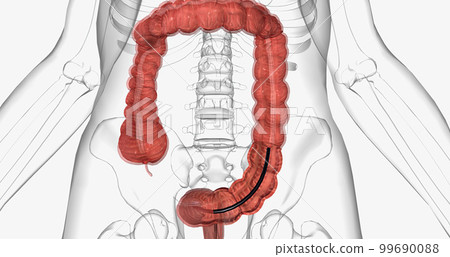 Colonoscopy is an invasive procedure used to look inside the large intestines. 99690088