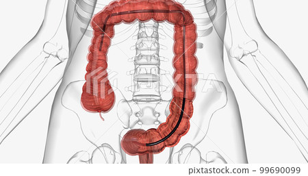 Colonoscopy is an invasive procedure used to look inside the large intestines. Colonoscopy is an invasive procedure used to look inside the large intestines. 99690099