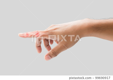 Inflammation of Forefinger bone. Inflammation of Forefinger bone. 99690917