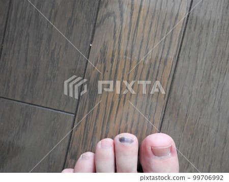 腳趾甲內出血 內出血 左腳趾出血 腳趾甲內出血 內出血 左腳趾出血 99706992