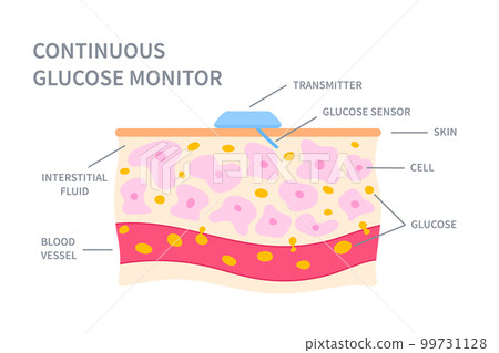 Continuous glucose monitor sensor in skin illustration 99731128