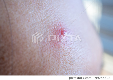 Inflammatory acne with red spot on face closeup 99745498