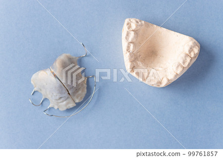 Removable orthodontic plate and plaster cast of child's jaw on blue background. Removable orthodontic plate and plaster cast of child's jaw on blue background. 99761857