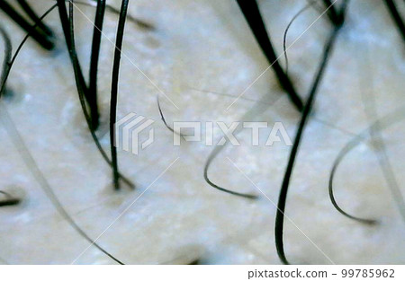 Microscope scalp enlargement thinning hair 99785962