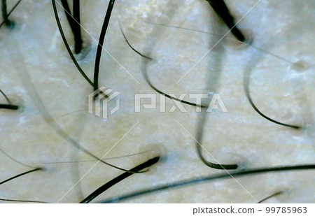 Microscope scalp enlargement thinning hair 99785963