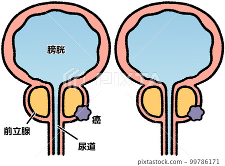 prostate cancer 99786171