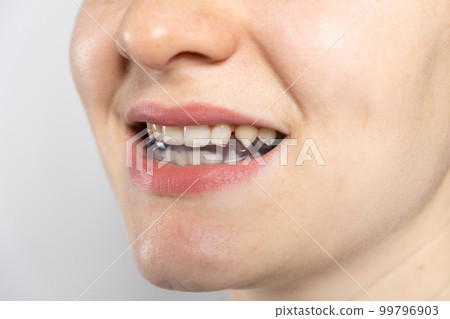 Dental mouthguard, splint in the mouth for the treatment of dysfunction of the temporomandibular joints, bruxism, malocclusion, to relax the muscles of the jaw. 99796903